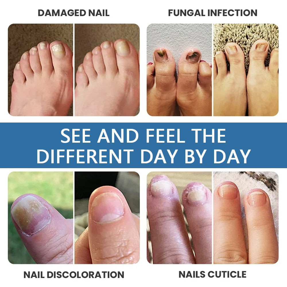🔥Limited Time Promotion 50% OFF🔥Nail Fungus Treatment Solution