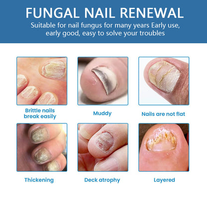 🔥Limited Time Promotion 50% OFF🔥Nail Fungus Treatment Solution