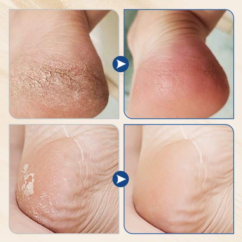 🔥Hydrating and Anti-Cracking Foot Cream